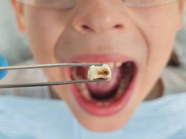 Best Same-Day Emergency Dental Services in Roodhouse, IL